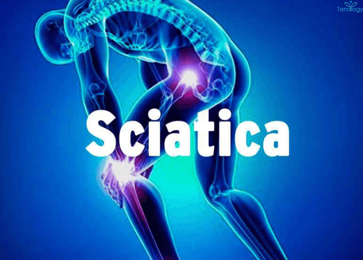 THW64-Understanding Sciatica: Exploring Symptoms, Causes and Treatment Options