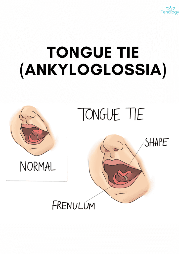 THW62- Tongue Tie (Ankyloglossia): Causes, Symptoms & Treatment