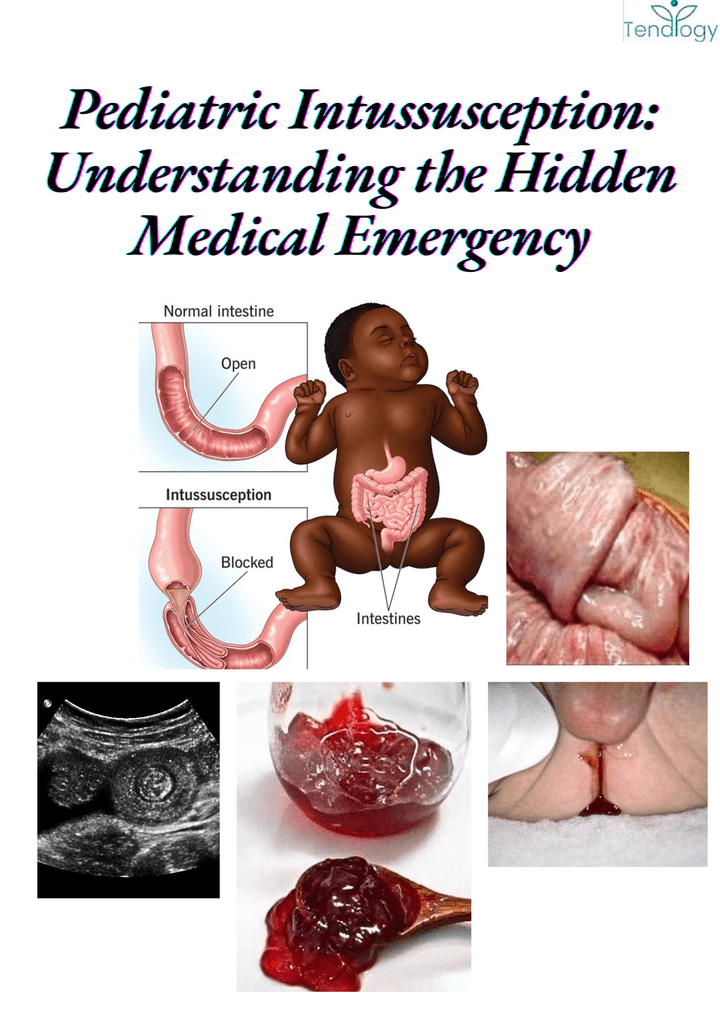 THW53- Pediatric Intussusception: Understanding the Hidden Medical Emergency